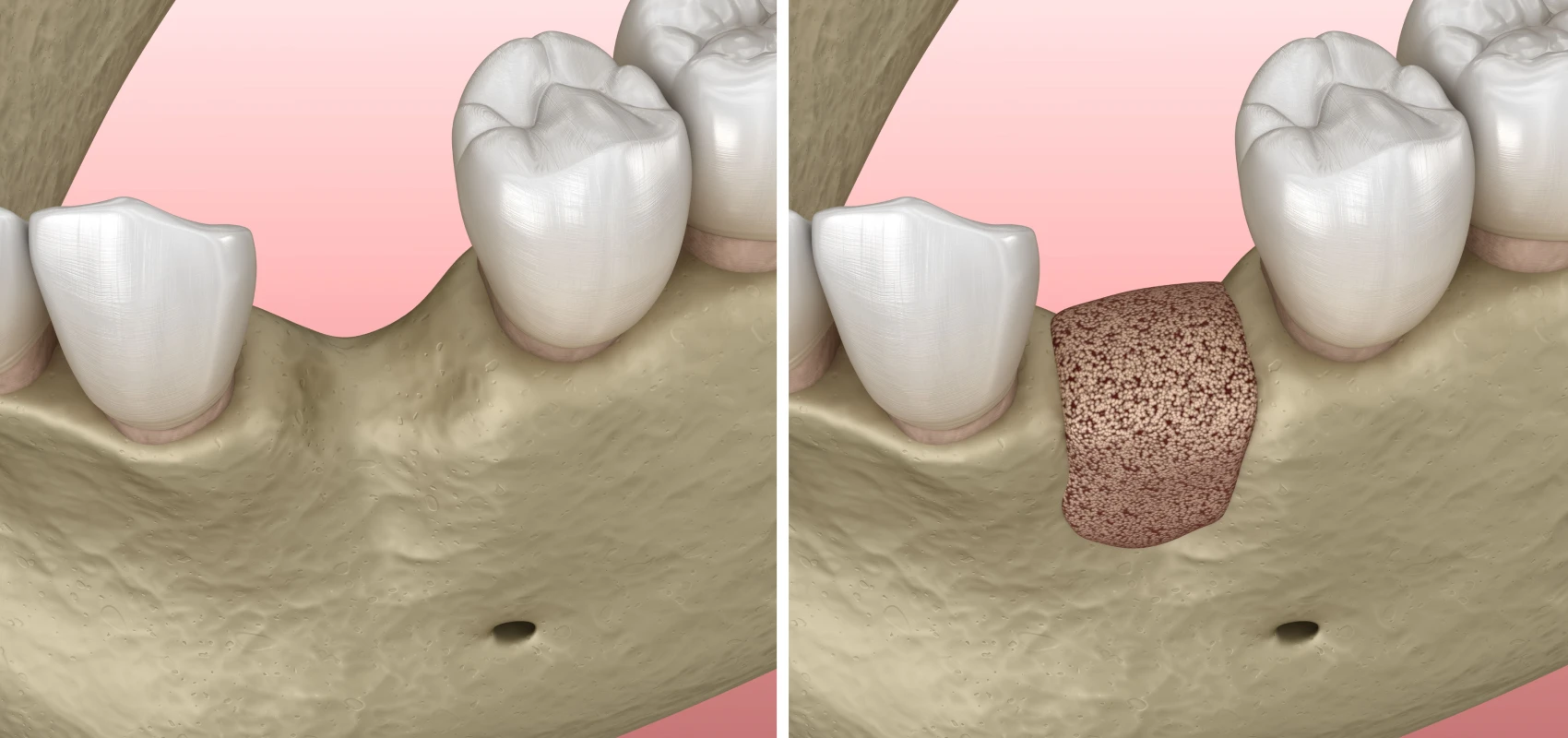 greffes osseuses parodontologie chirurgicale Chirurgie orale Cabinet CDA | Chirurgiens-dentistes à Alby-sur-Chéran
