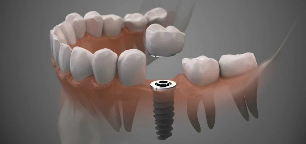 implants dentaires Soins dentaires Cabinet CDA | Chirurgiens-dentistes à Alby-sur-Chéran