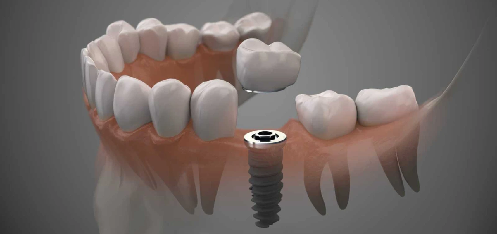 implants dentaires Implants dentaires Cabinet CDA | Chirurgiens-dentistes à Alby-sur-Chéran