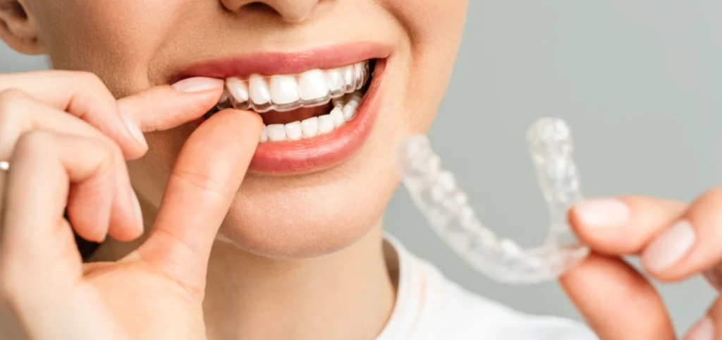 aligneur invisible orthodontie Soins dentaires Cabinet CDA | Chirurgiens-dentistes à Alby-sur-Chéran