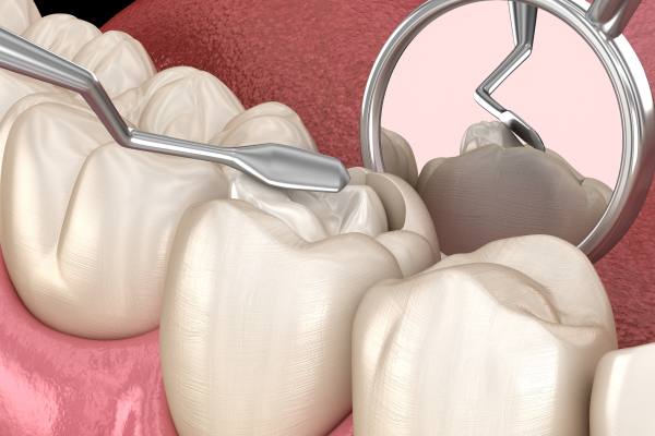 carie composite restauration Soins conservateurs Cabinet CDA | Chirurgiens-dentistes à Alby-sur-Chéran