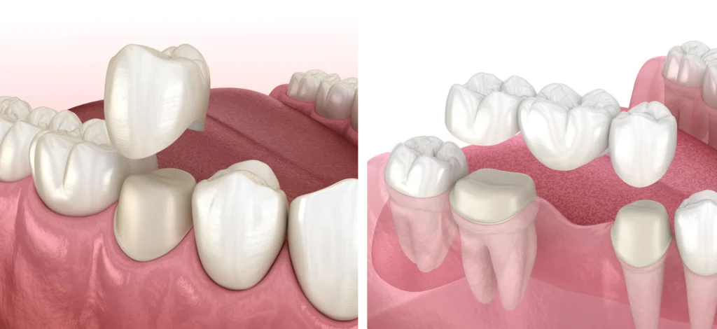 couronnes ponts bridge dentaire x Soins dentaires Cabinet CDA | Chirurgiens-dentistes à Alby-sur-Chéran