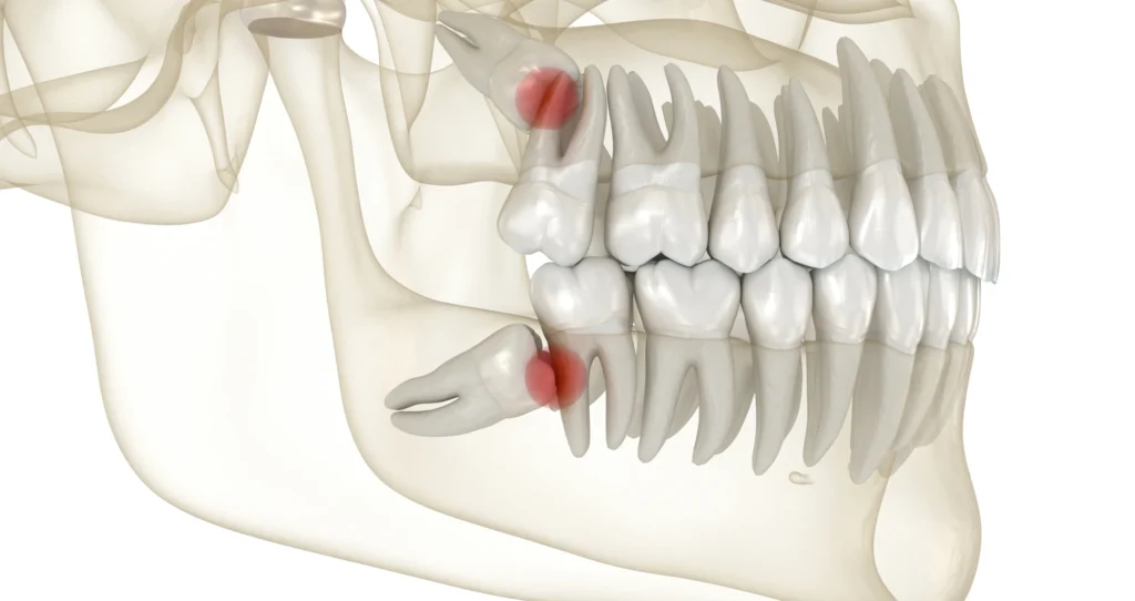 dents sagesse extraction dentiste alby sur cheran Chirurgie orale Chirurgien-dentiste Alby-sur-Chéran - Dr Paulin CARTIER