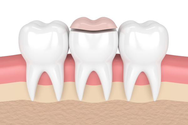 onlay soins conservateurs dentaire Soins conservateurs Cabinet CDA | Chirurgiens-dentistes à Alby-sur-Chéran