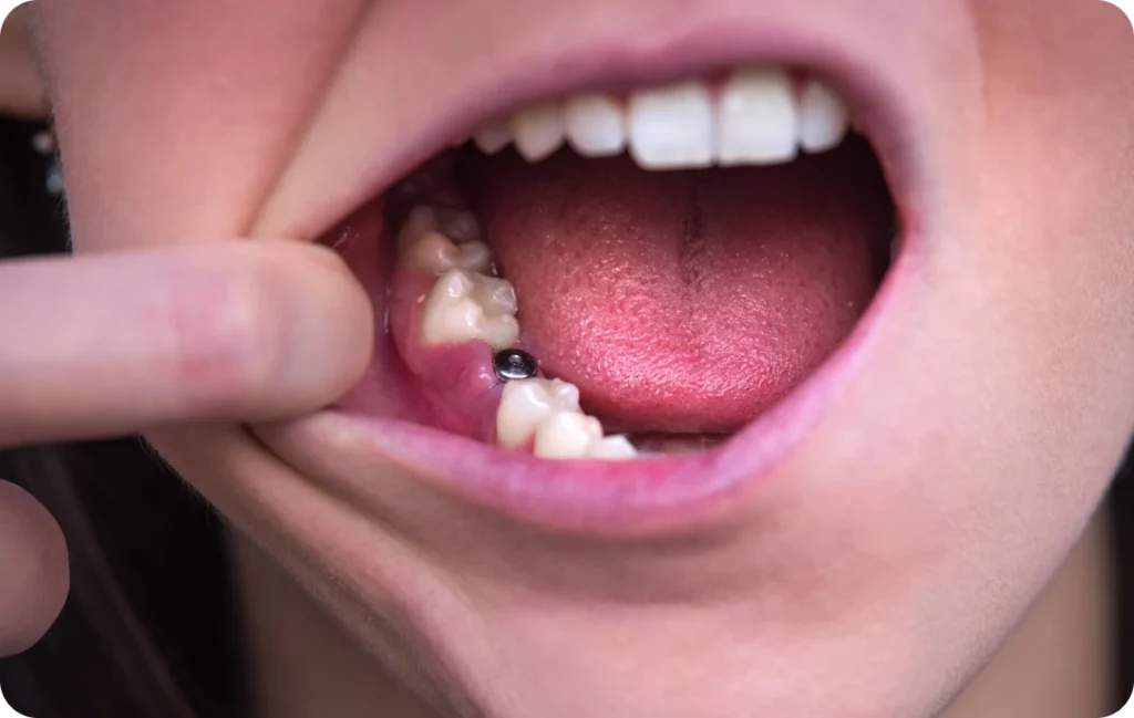 implant dentaire aix les bains dentiste Dentiste à Aix-les-Bains : implants dentaires Cabinet CDA | Chirurgiens-dentistes à Alby-sur-Chéran